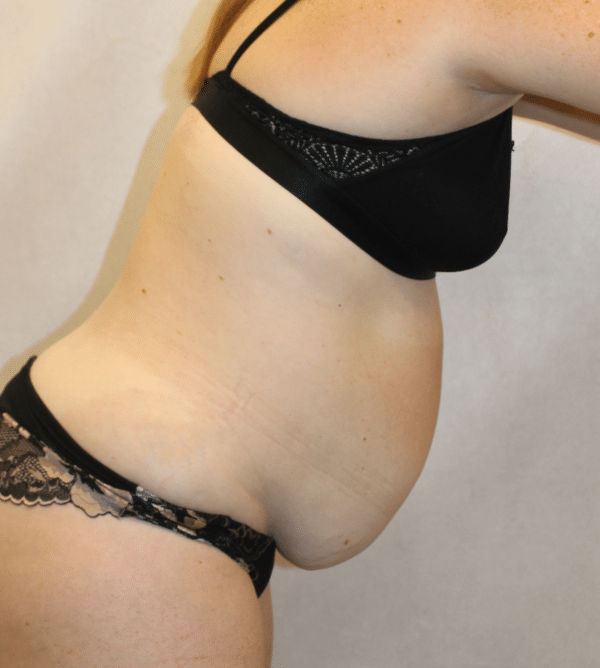 Body Procedures