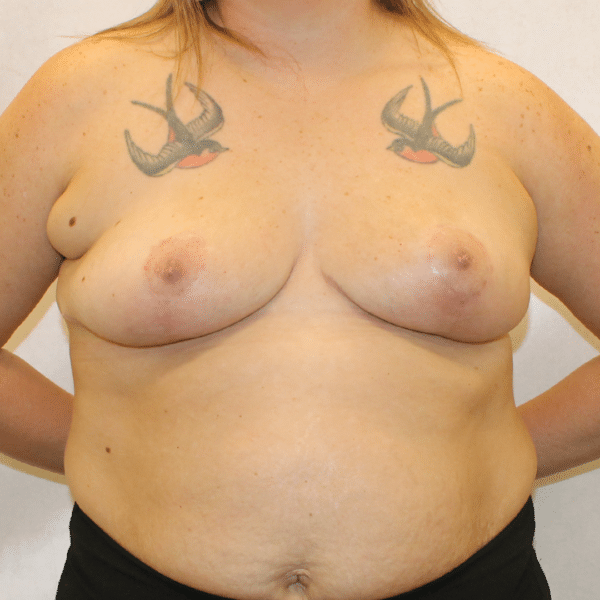 Breast Lift