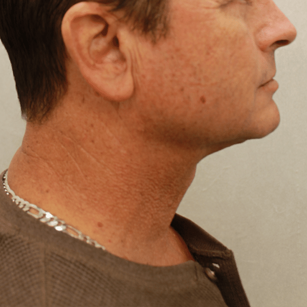 Face Procedures