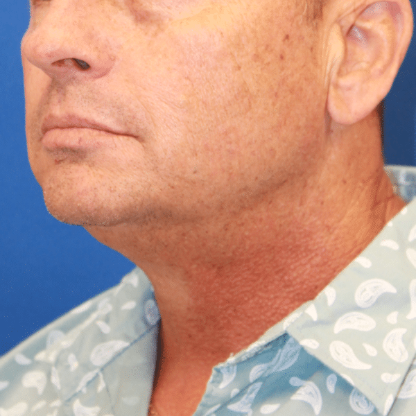 Face Procedures