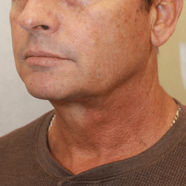 Face Procedures