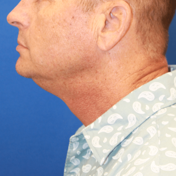 Face Procedures