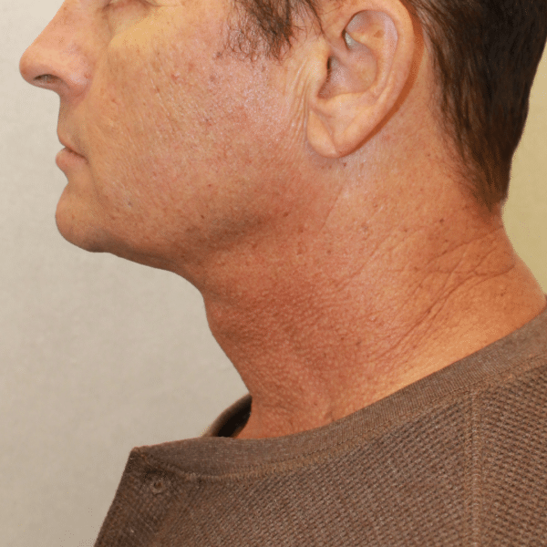 Face Procedures