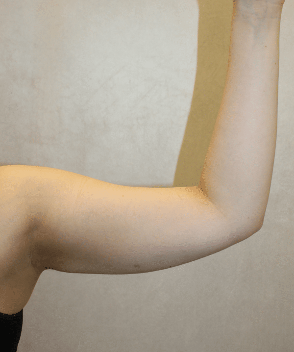 Liposuction