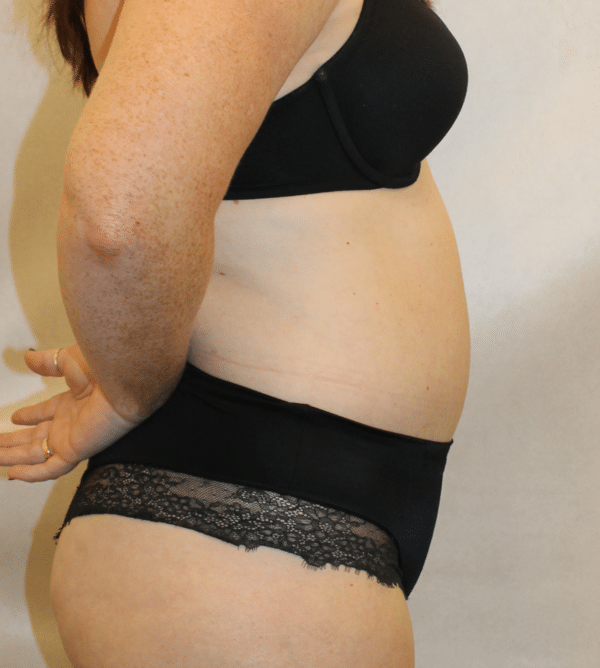 Body Procedures