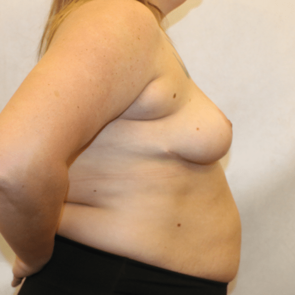 Breast Lift