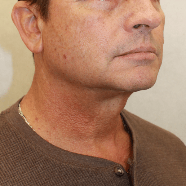 Face Procedures