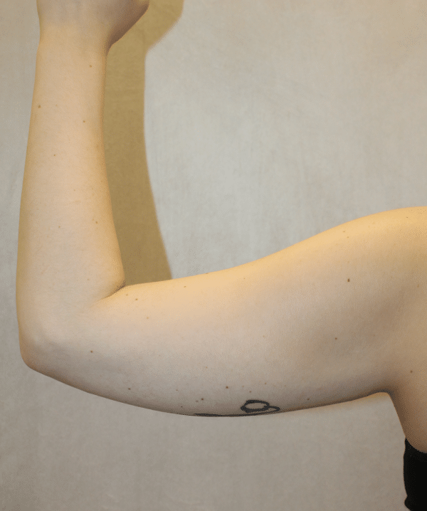 Liposuction