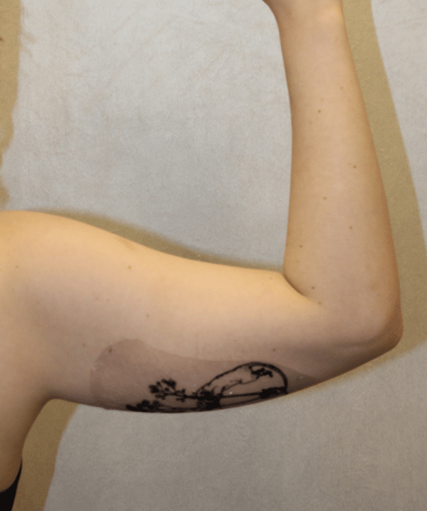 Liposuction