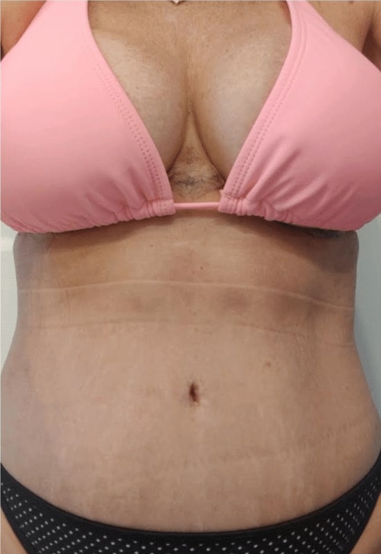 Reverse Upper Modified Lower Abdominoplasty