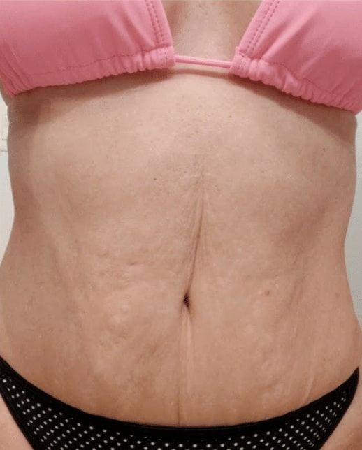 Before Reverse Tummy Tuck Gainesville FL