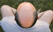 balding