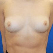 breast before