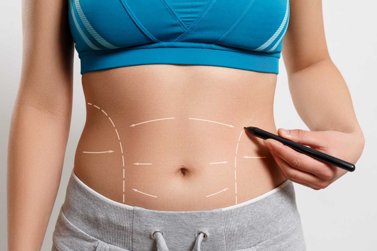 Am I a Candidate for a Tummy Tuck?