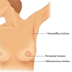 implant incision