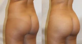 butt-side