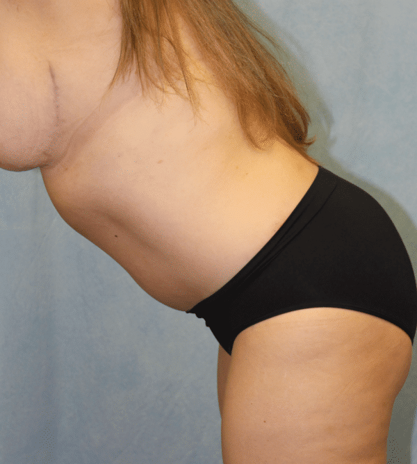 After Image: Case #5446 – Mommy Makeover - left-front-oblique