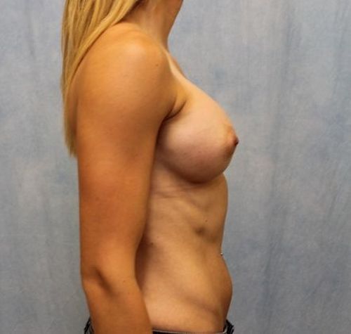 After Image: Case #117 – Breast Augmentation -