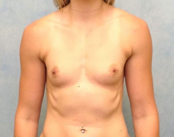 Before Image: Case #117 – Breast Augmentation - front