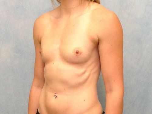 Before Image: Case #117 – Breast Augmentation -