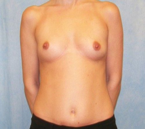 Case #171 – Breast Augmentation