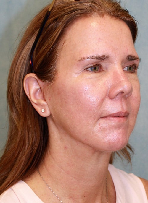 After Image: Case #1768 – Facelift - right-front-oblique