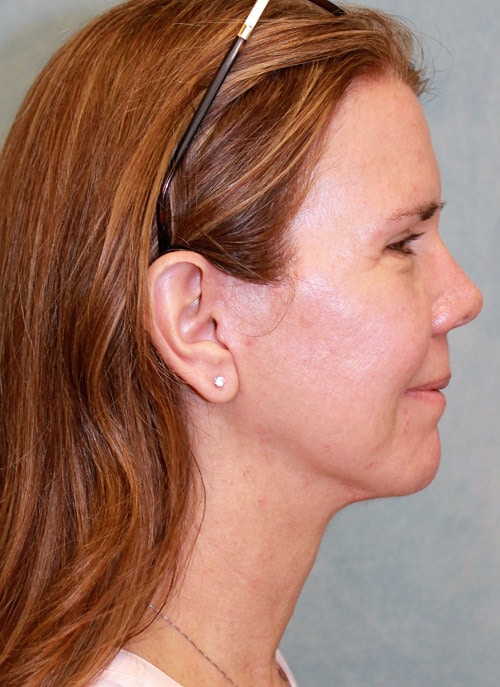 After Image: Case #1768 – Facelift - right-side