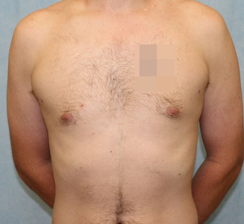 Case #1814 – Male Breast Reduction