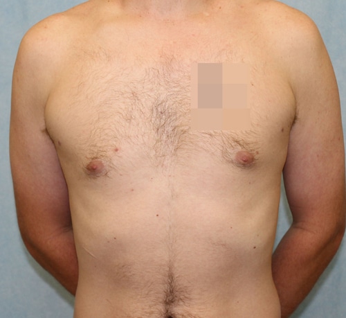 After Image: Case #1814 – Male Breast Reduction - front
