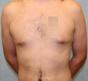 Case #1814 – Male Breast Reduction