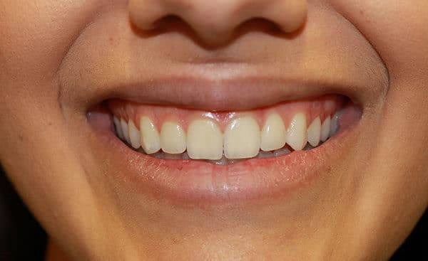 Case #1820 – Gummy Smile Botox