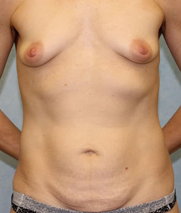 Before Image: Case #1836 – Mommy Makeover - front
