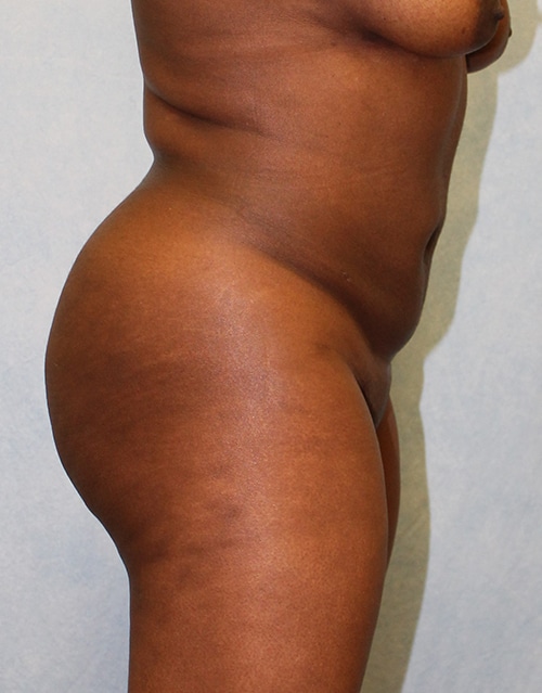After Image: Case #1889 – Brazilian Butt Lift - right-side