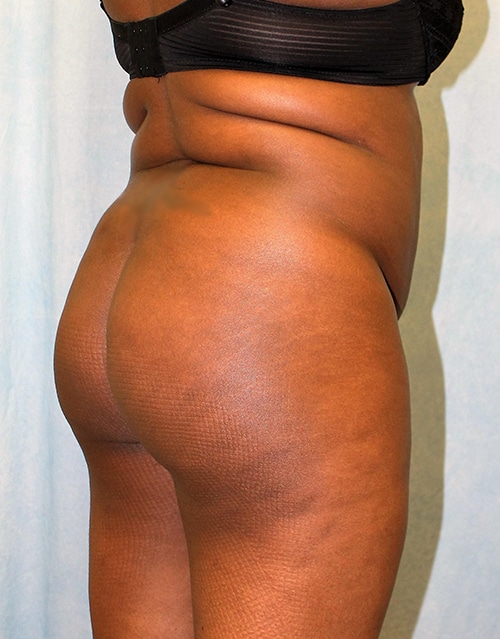 Before Image: Case #1889 – Brazilian Butt Lift