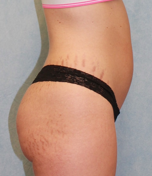 Before Image: Case #1891 – Brazilian Butt Lift - right-side