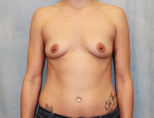 Case #207 – Breast Augmentation
