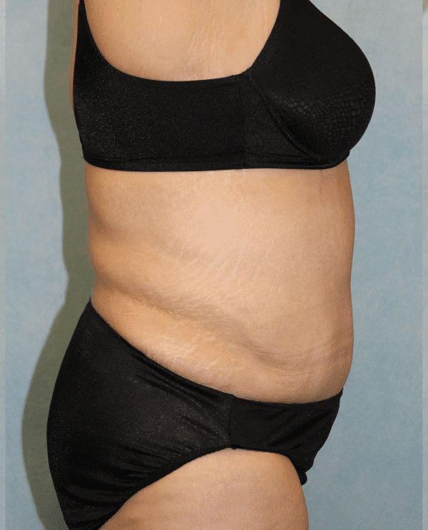 After Image: Case #2157 – Abdominoplasty + Monsplasty - right-side