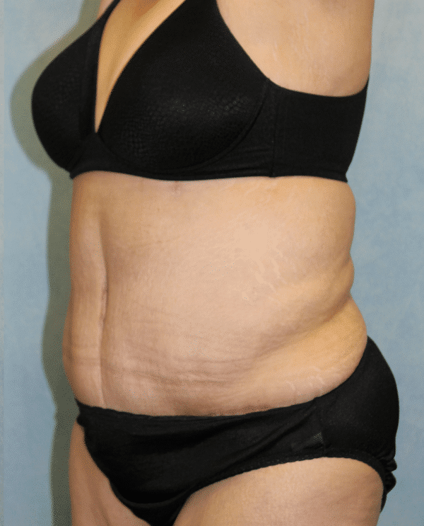 After Image: Case #2157 – Abdominoplasty + Monsplasty - left-front-oblique