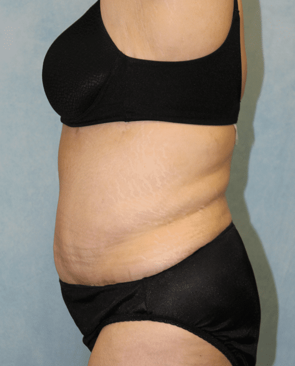 After Image: Case #2157 – Abdominoplasty + Monsplasty - left-side