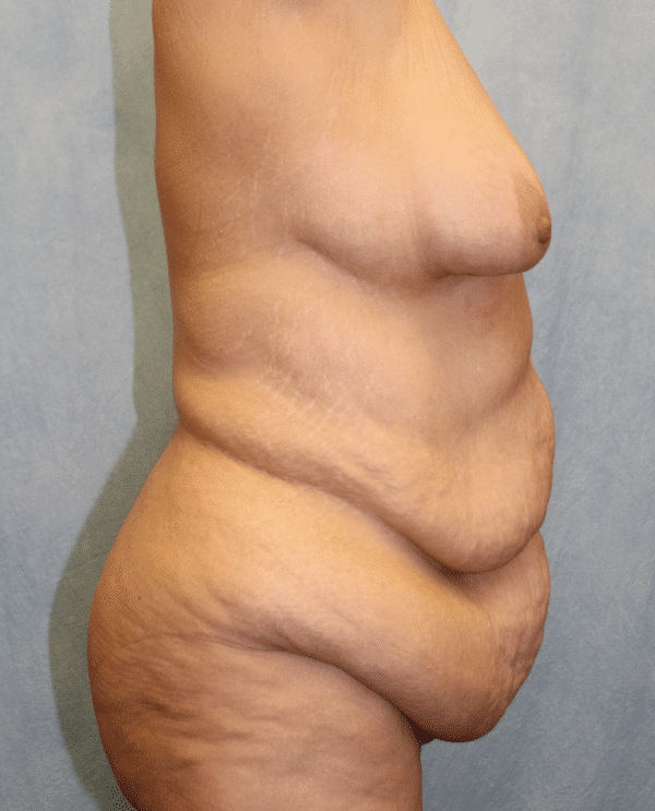 Before Image: Case #2157 – Abdominoplasty + Monsplasty - right-side