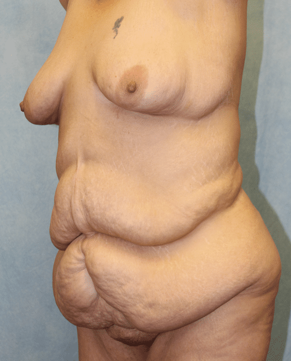 Before Image: Case #2157 – Abdominoplasty + Monsplasty - left-front-oblique