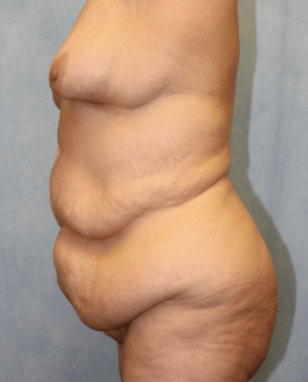 Before Image: Case #2157 – Abdominoplasty + Monsplasty - left-side