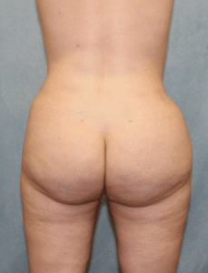 Case #2168 – Brazilian Butt Lift