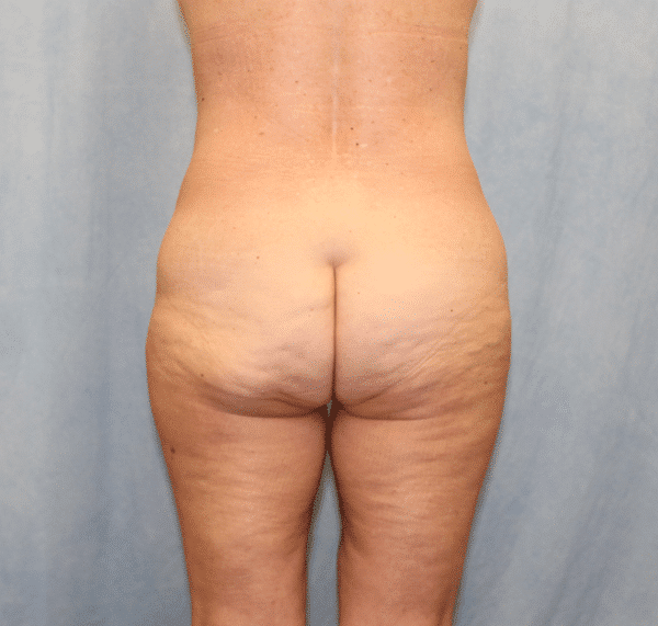 Case #2177 – Brazilian Butt Lift