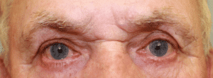 Case #2192 – Eye Lift (Blepharoplasty)