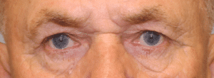 Case #2192 – Eye Lift (Blepharoplasty)
