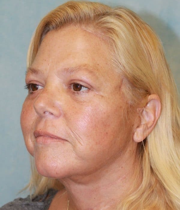 After Image: Case #2200 – Facelift - left-front-oblique
