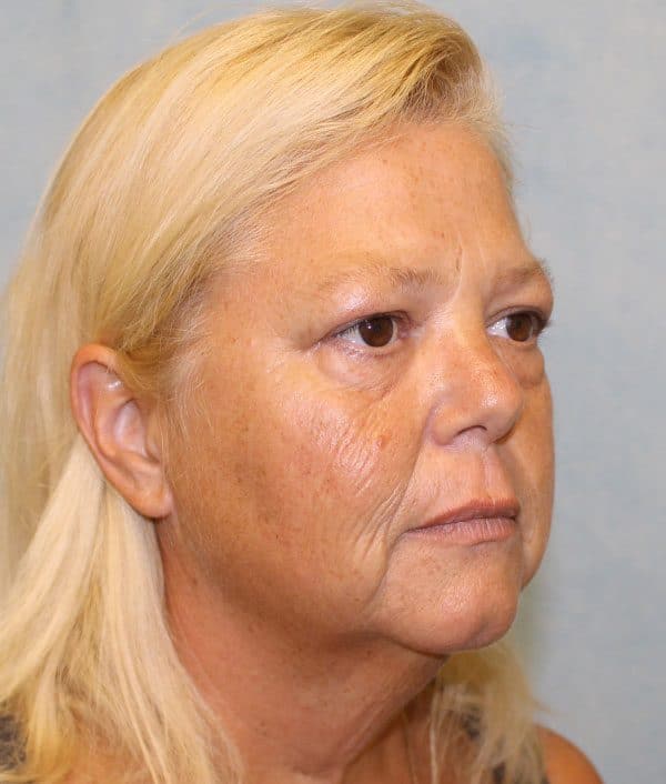 Before Image: Case #2200 – Facelift - right-front-oblique
