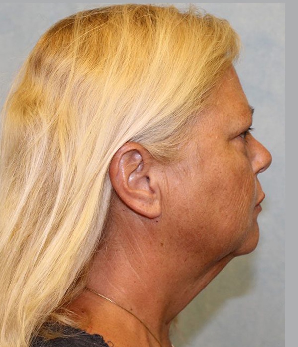 Before Image: Case #2200 – Facelift - right-side