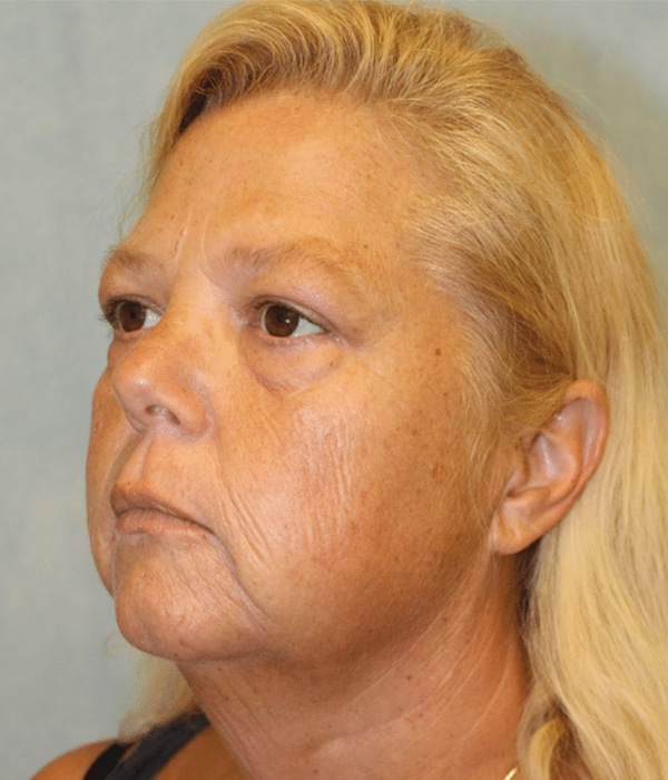 Before Image: Case #2200 – Facelift - left-front-oblique